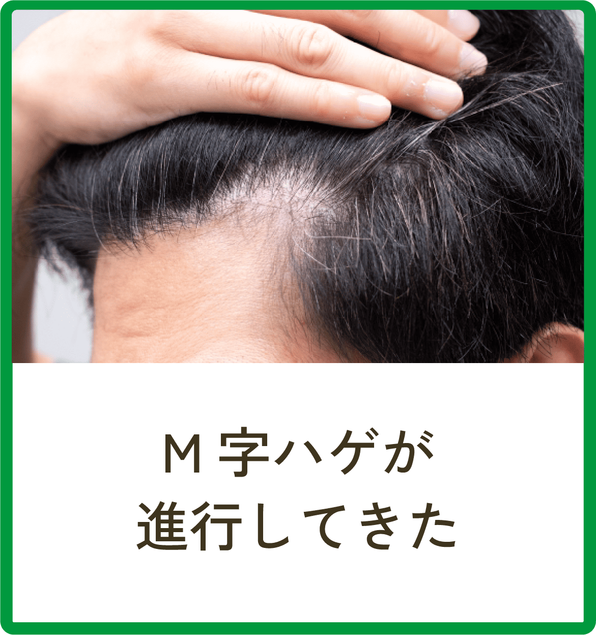 M字ハゲが進行してきた