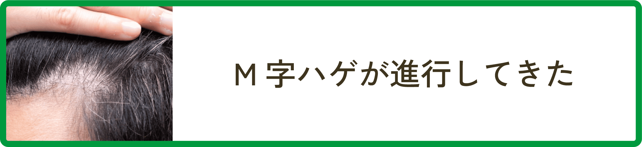 M字ハゲが進行してきた