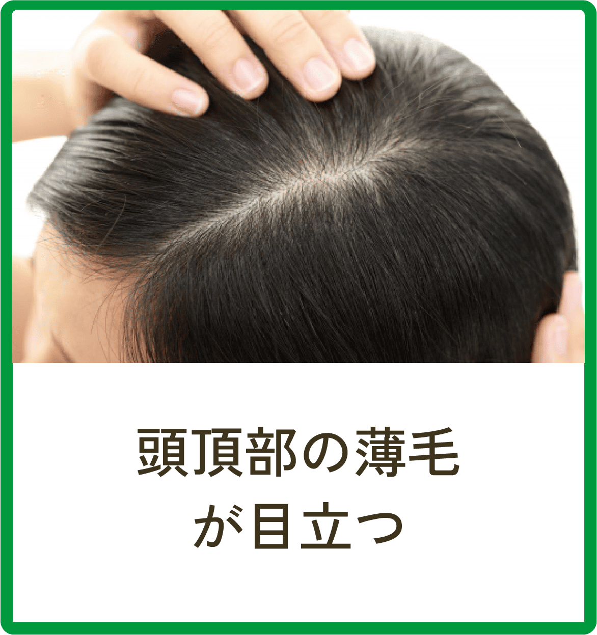 頭頂部の薄毛が目立つ