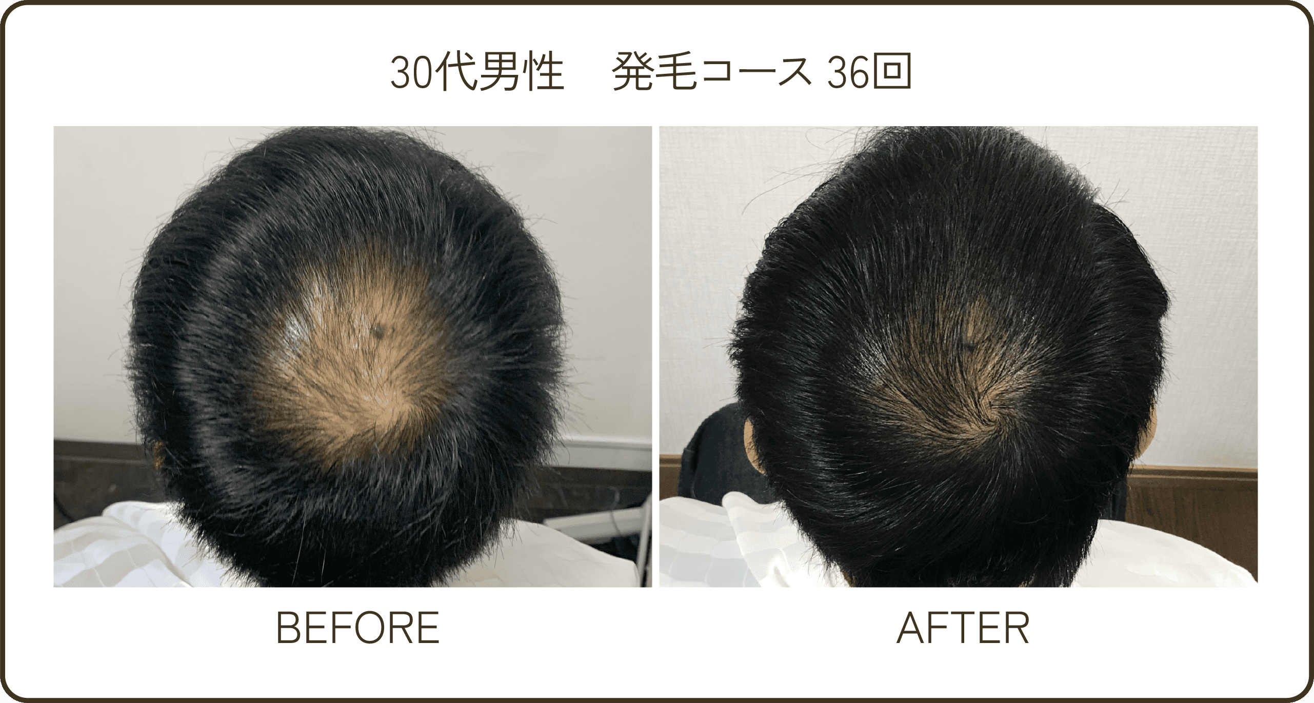 40代男性発毛コース24回