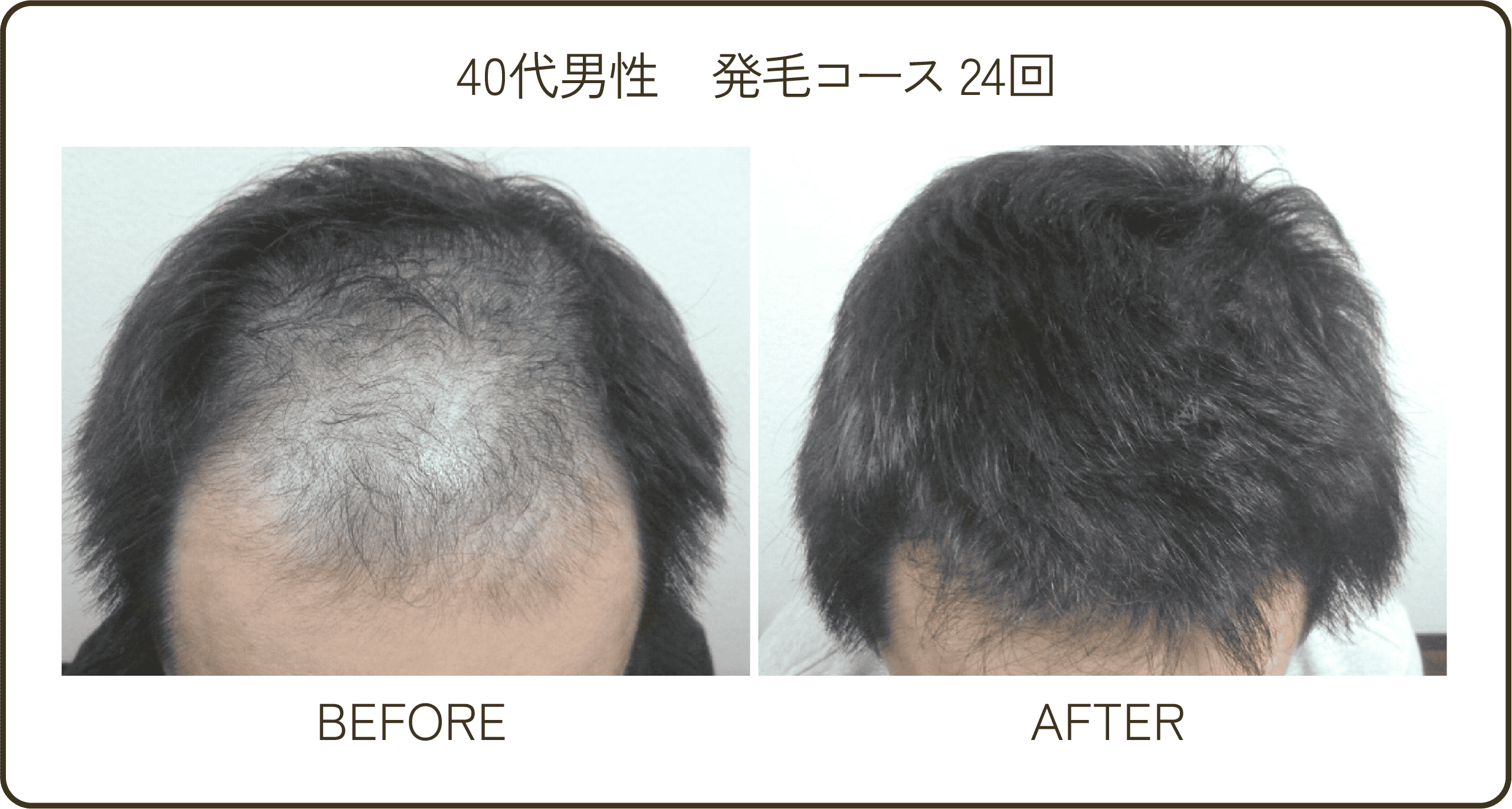 30代男性発毛コース36回